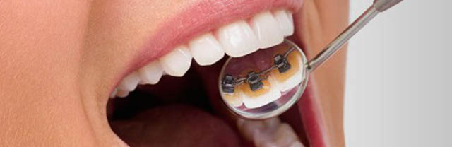 Lingual Braces